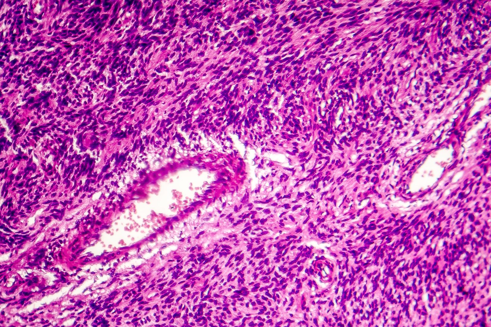 mikroskopaufnahme fibrosarkom tumor