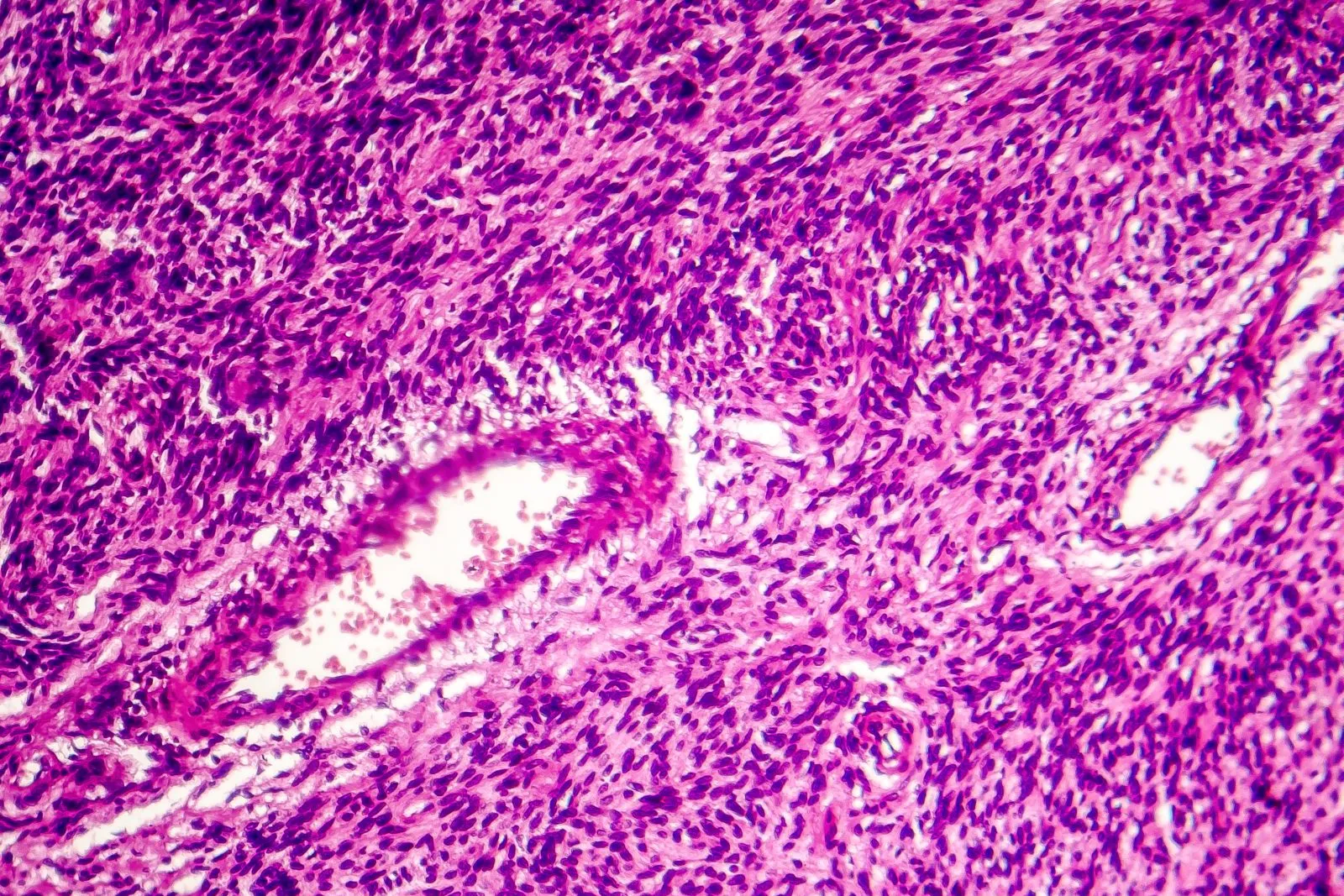 Eine mikroskopische Aufnahme eines Fibrosarkoms mikroskopaufnahme fibrosarkom tumor